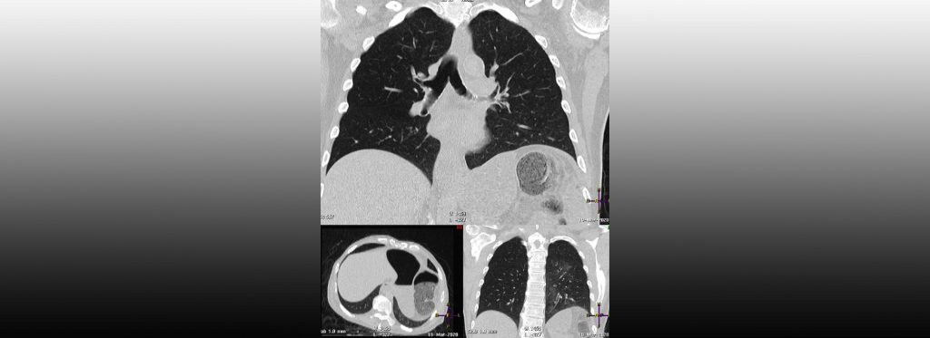 CT scans of a deceased person's chest cavity