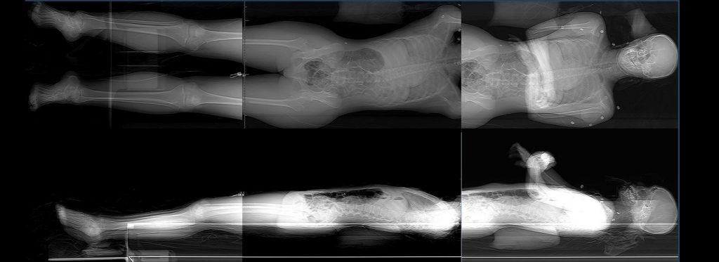 Full body x-ray scans of a deceased individual